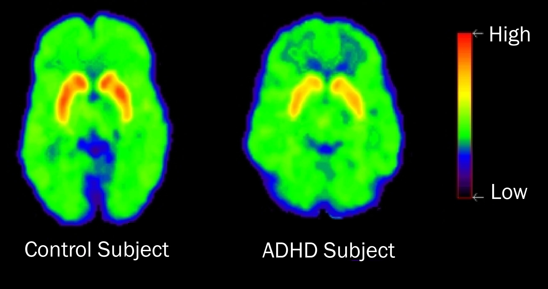 ADHD is a dopamine disorder, not a learning disability. – Trans Icarus